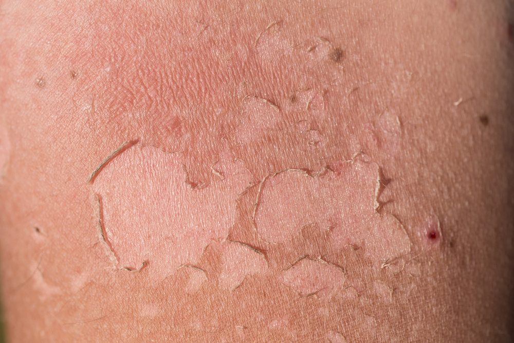 sunburn