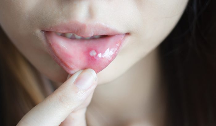 Woman with aphthae on lip.