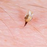 how to identify bee stings