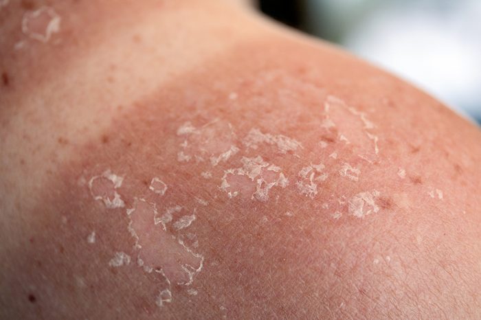 Peeling skin at back and shoulder from a sunburn.