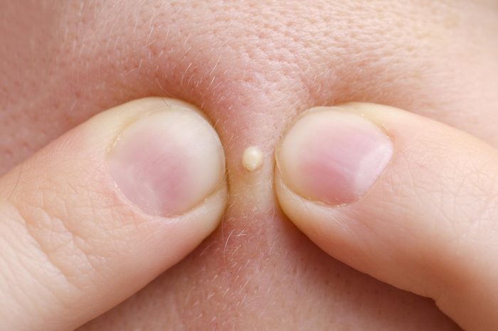 Pus-filled pimple that is about to be popped.