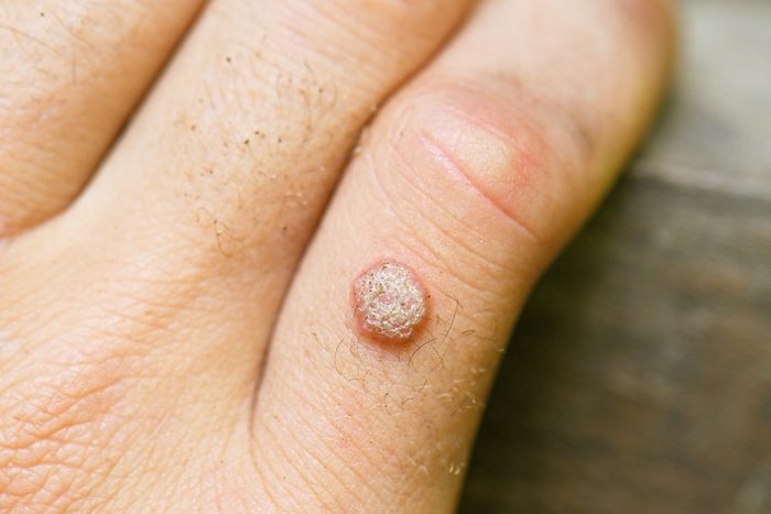 Wart on the hand finger.
