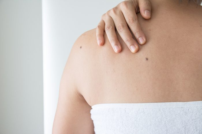 Moles on the women skin