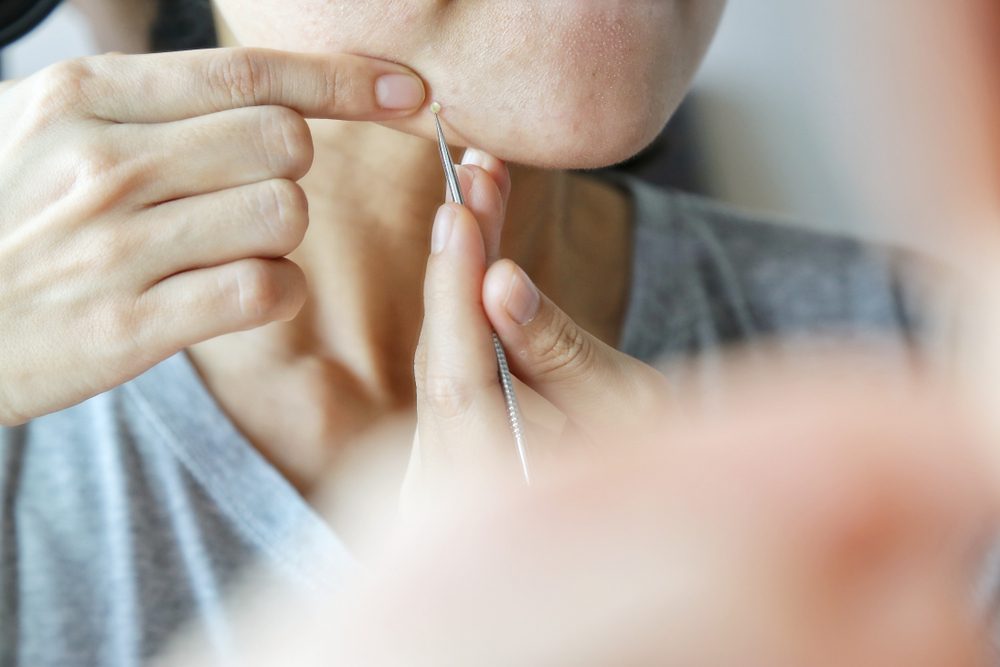 Woman uses her hand to squeeze pimples on her face in front of mirror with needle. Concept of skin care, acne treatment equipment, pop pimples.