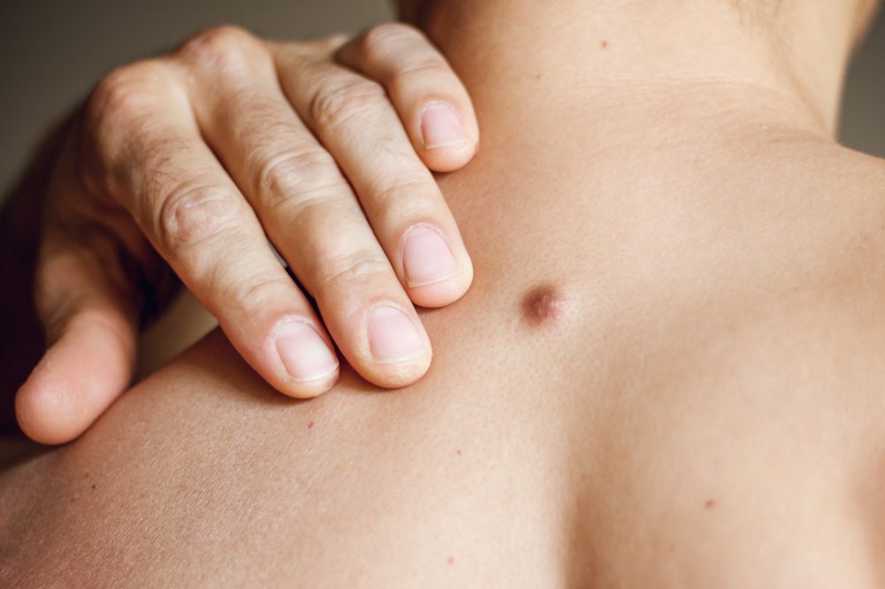 Fibroma on man's back