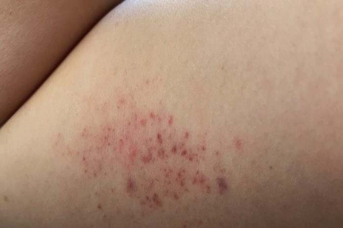 petechiae hemorrhage broken caplilaries