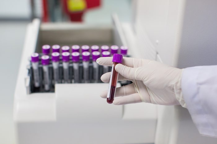 Technician wearing glove holding blood tube for Complete blood count (CBC) by automation