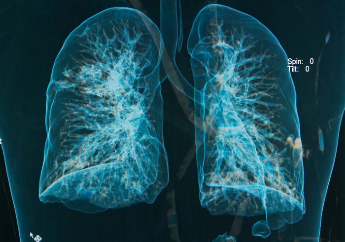 Thoracic spine X-rays under 3d image