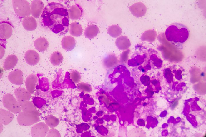 Abnormal neutrophil in pleural fluid smear.Sepsis or septicaemia is a life-threatening illness. Presence of numerous bacteria in the blood, causes the body to respond in organ dysfunction.