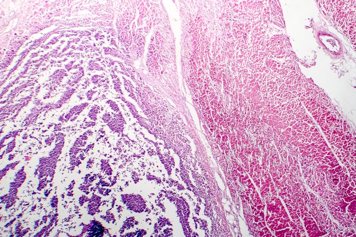 Histopathology of bacterial myocarditis, inflammatory heart disease, light micrograph