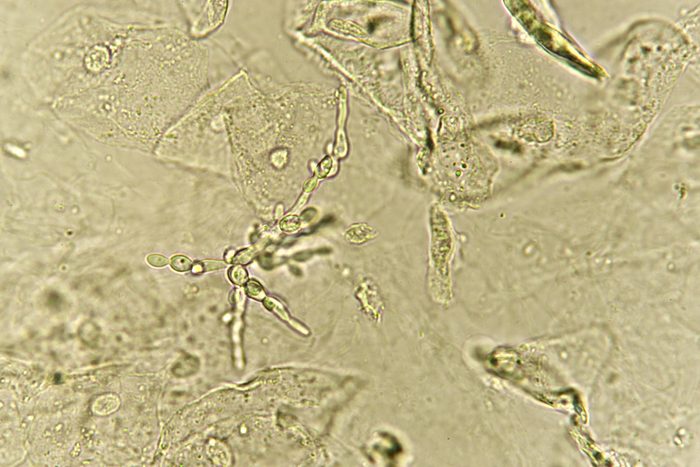 13 Common Infections That Can Raise Your Heart Attack Risk