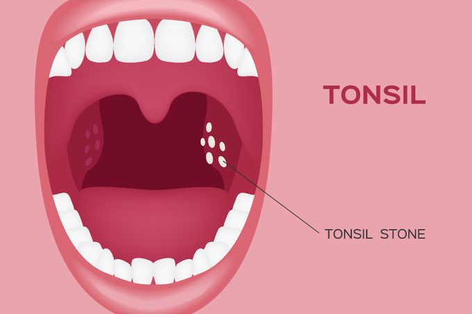 tonsil stones