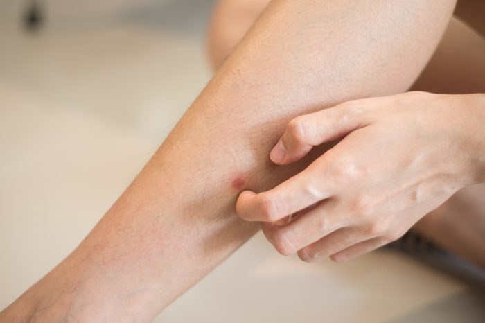 Woman hand scratching on leg, Concept with Healthcare And Medicine.