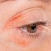 8 Tips for Dealing With Psoriasis on Your Eyelids