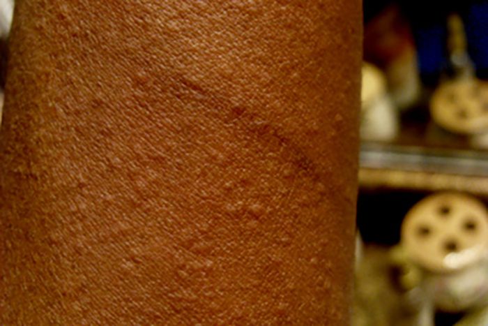 Cholinergic Urticaria