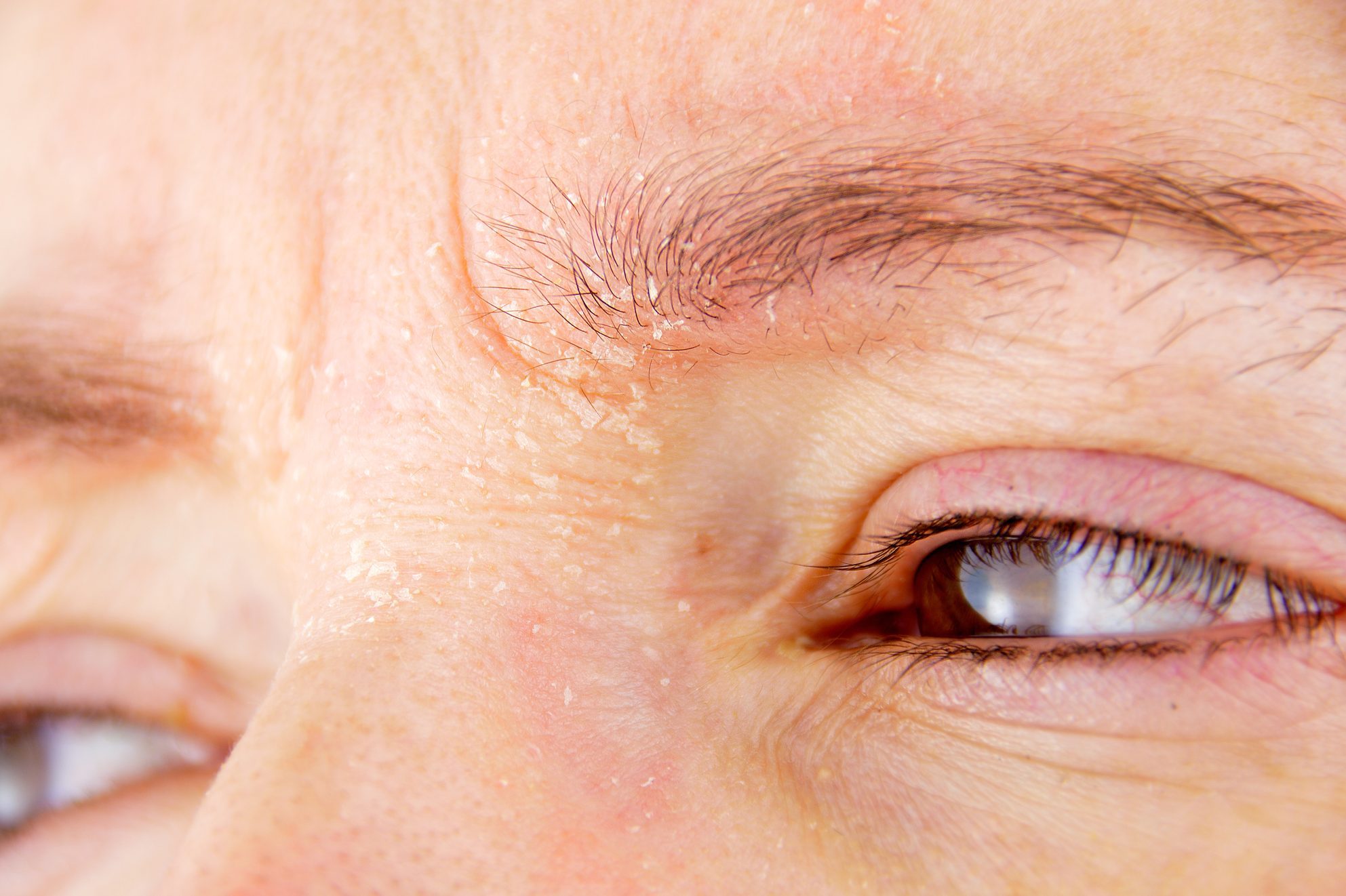 woman with atopic dermatitis