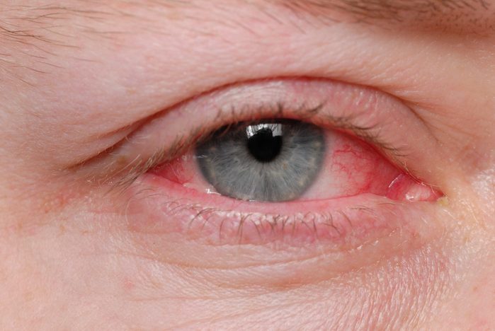 Pink eye