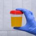 New Research: High Protein in Urine Predicted Sudden Cardiac Arrest Risk for One Surprising Group