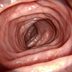 Is Constipation After a Colonoscopy Normal? A Cleveland Clinic G.I. Doctor Explains