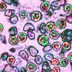 Measles Cases Have Just Been Confirmed in 4 More States