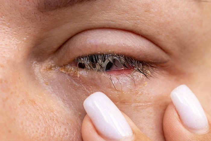What Conditions Are Commonly Misdiagnosed As Pink Eye