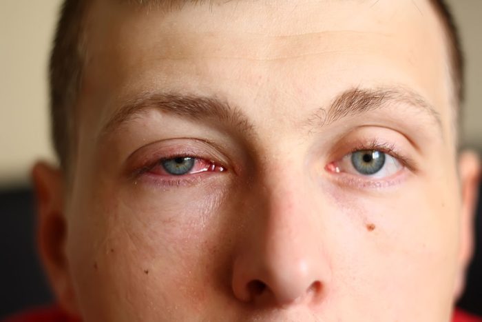 What Conditions Are Commonly Misdiagnosed As Pink Eye Gettyimages 497016331