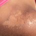 11 Signs Your Sunburn Is Actually Sun Poisoning, According to Expert Dermatologists