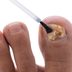 4 Types of Toenail Fungus and How To Treat Them