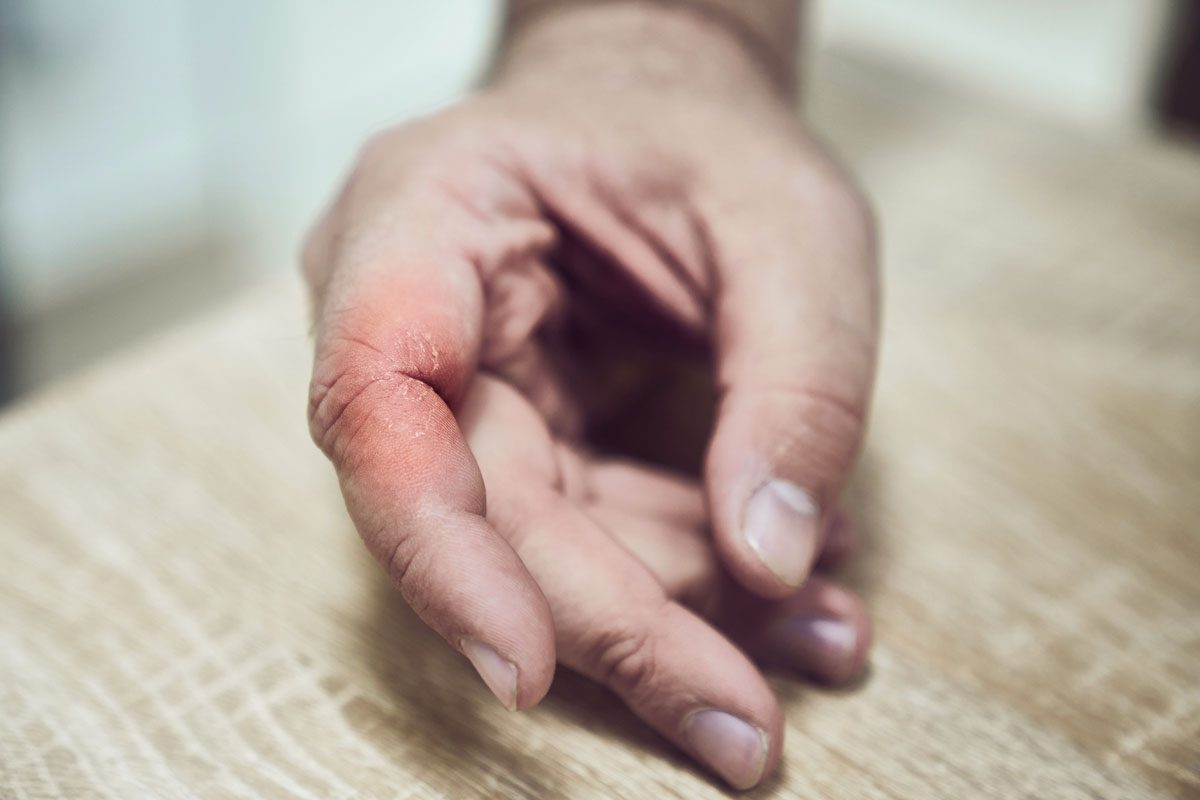 psoriasis on hand the hand of a man
