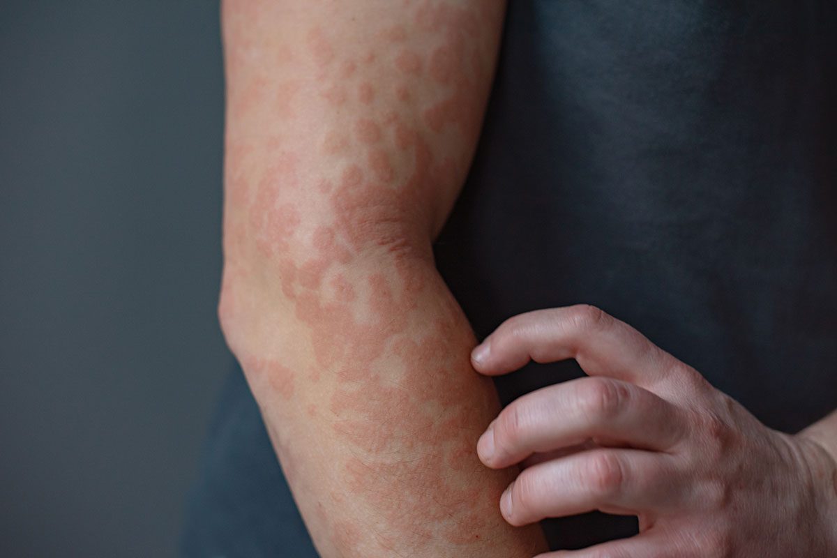 man scratching red, itchy skin