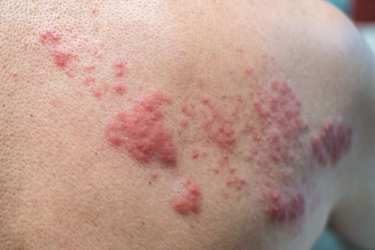 shingles rash