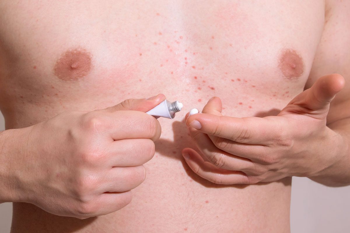 Man Using Medical Ointment For Treatment Red Skin Rashes
