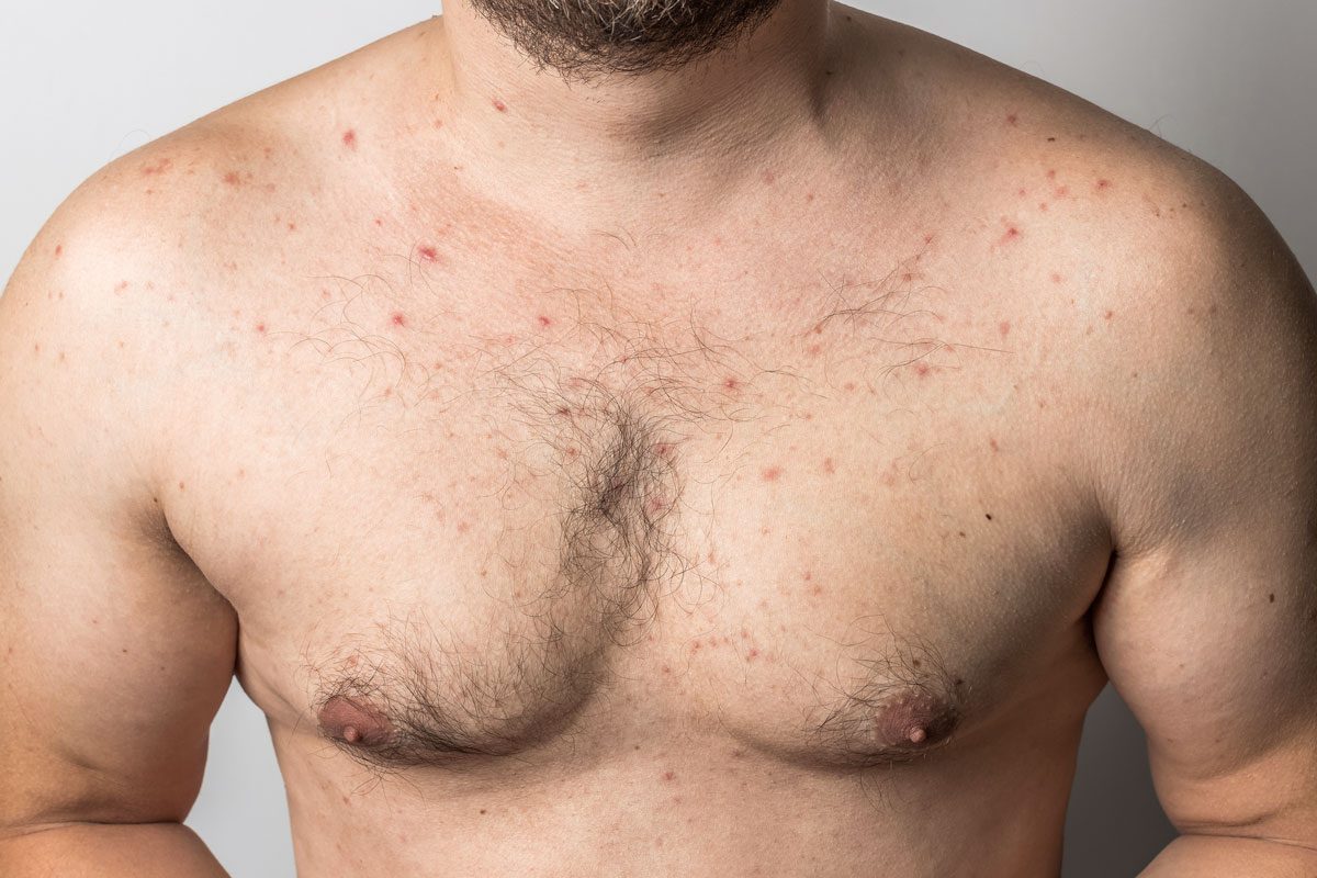 Naked Man With Chest Acne