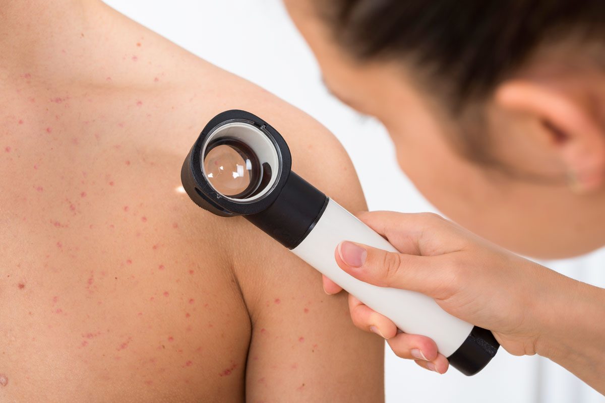 Person Examining Acne Skin With Dermatoscope