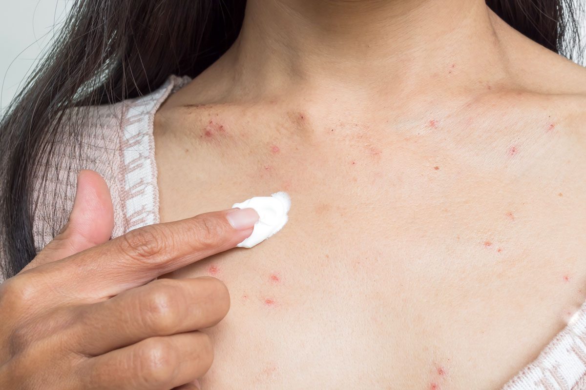 Woman With Chest Acne Applying Calamine Lotion Treatment