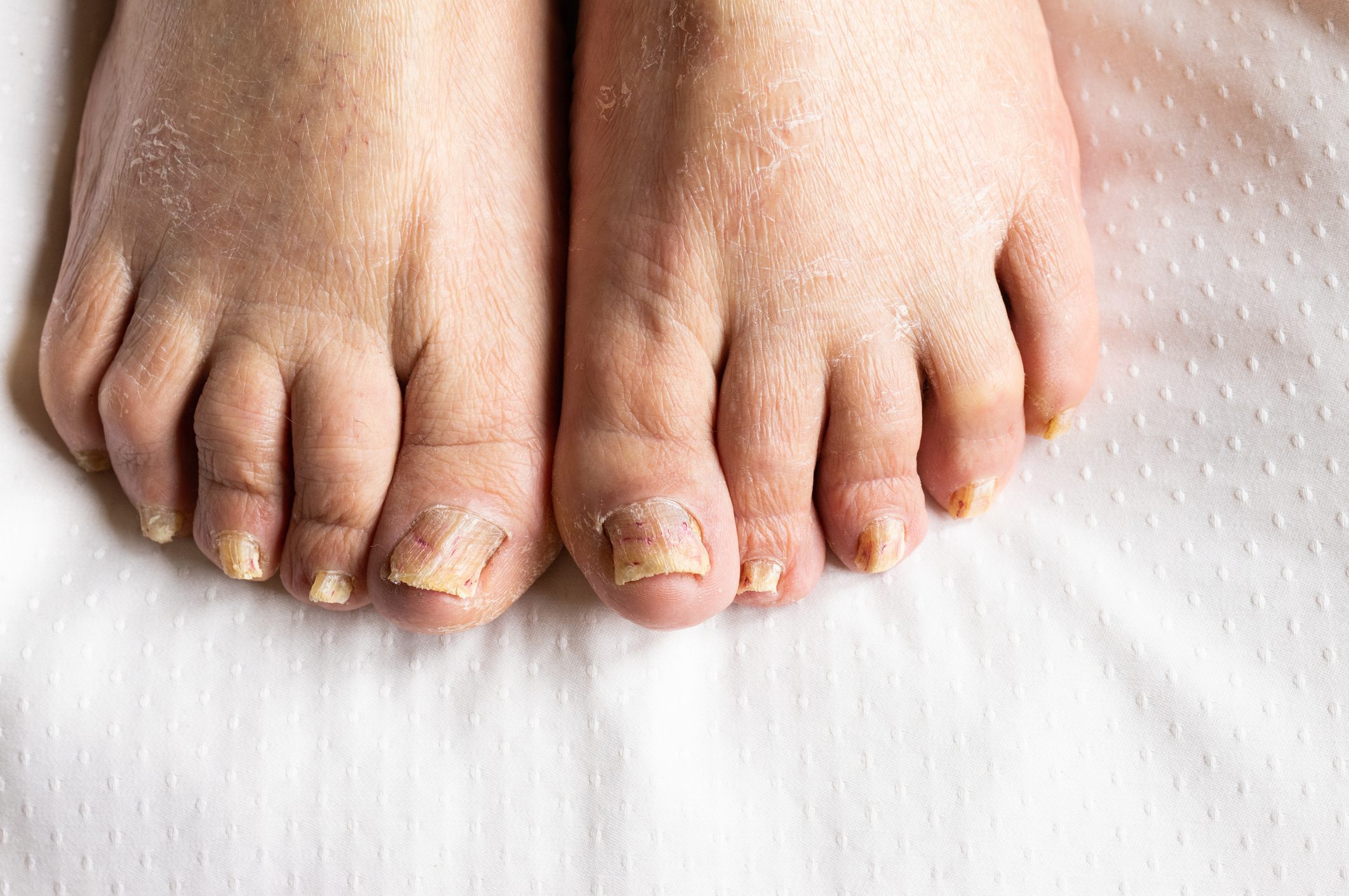 woman,s feet with long nails infected