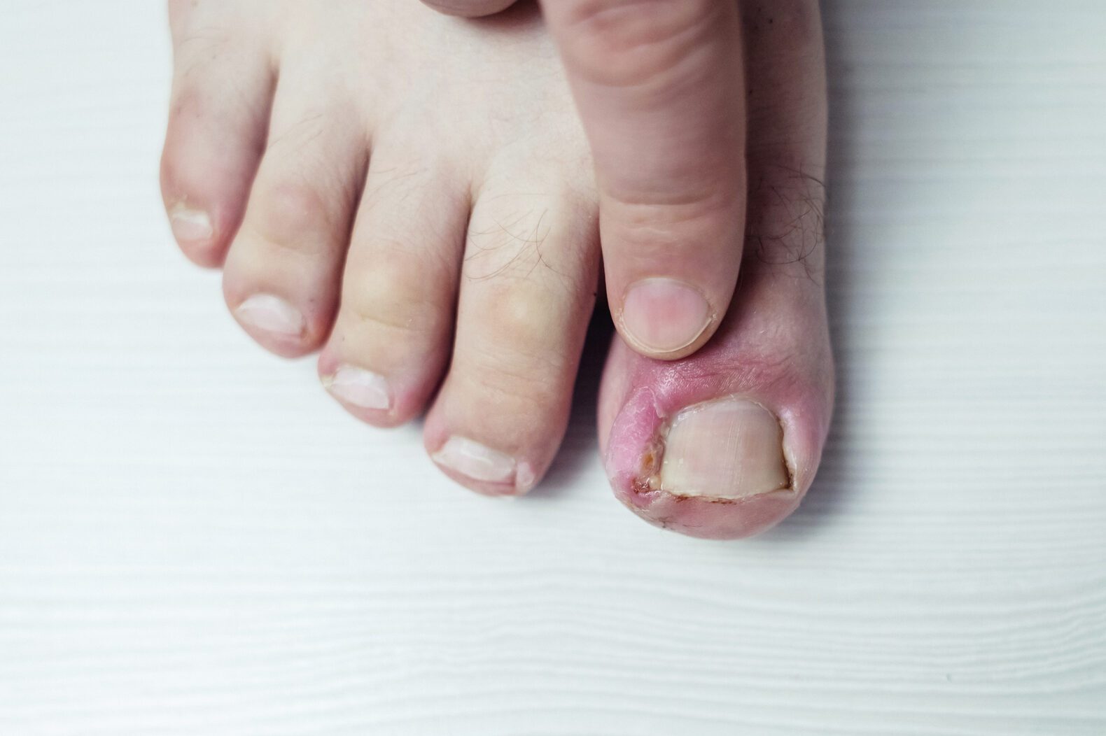 Finger infection. Paronychia, onychomycosis, nail psoriasis, longitudinal melanonychia, onychomadesis and retronychia. Inflammation of the big toe. Treatment of purulent diseases.