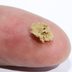 "Here's How I Knew I Had a Kidney Stone": A Patient's Story