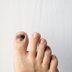 9 Things That Can Cause a Black Toenail and Treatments That Help