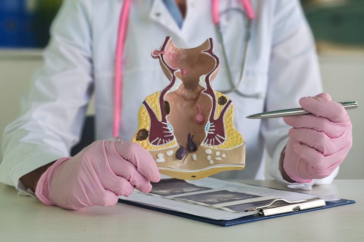 doctor holding a model of lower rectum