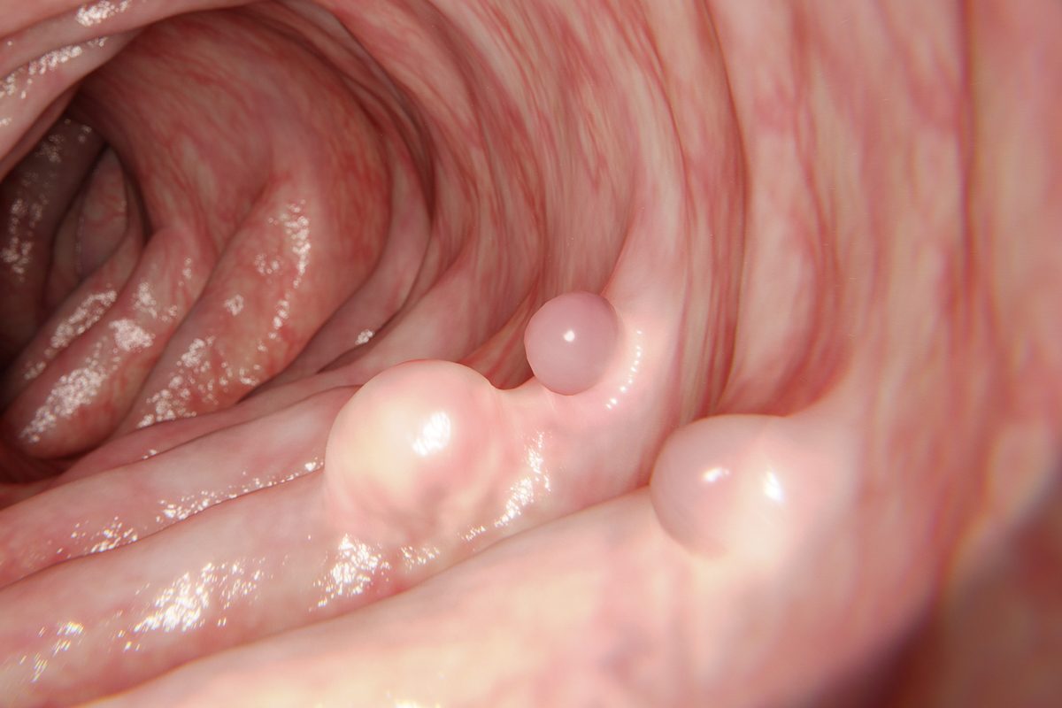 colon polyps